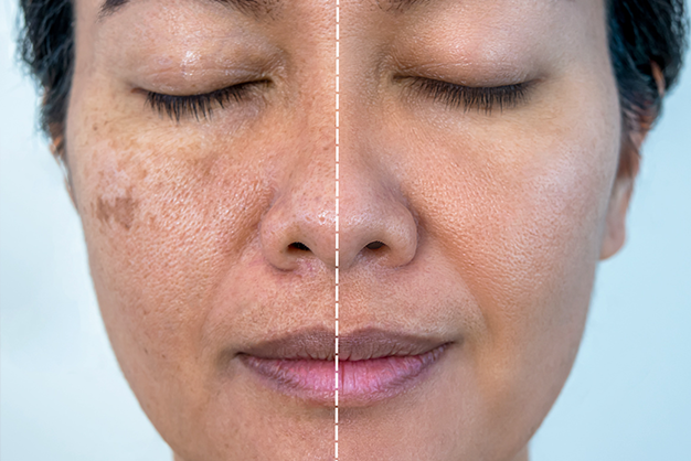 Melasma