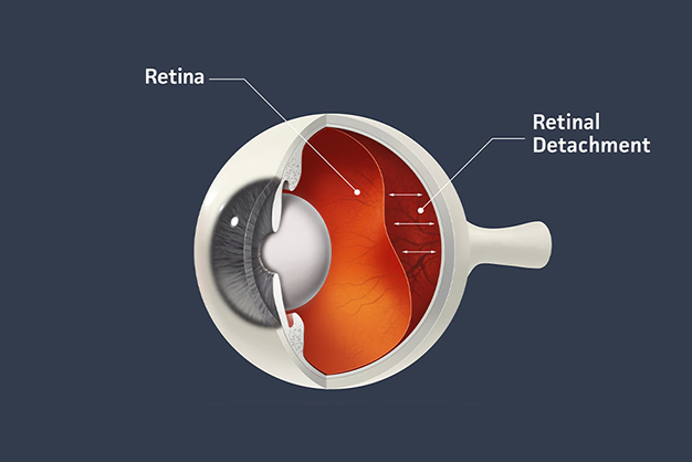 Retinal Detachment: Swift Action and Surgical Solutions for Eye Emergency