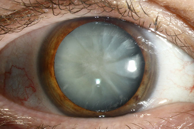 Navigating Cataracts: Unveiling Causes, Surgical Options, and the Path to Recovery