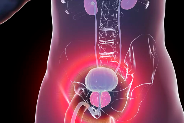 Benign Prostatic Hyperplasia (BPH): A  Common Condition as Men Age