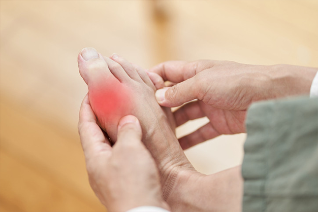 Gout: Understanding the Causes, Symptoms, and Dietary Management