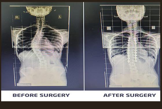 Caritas Hospital comforted the woman who came with her spinal curvature